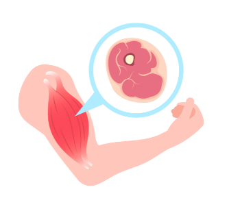 Sarcopenia