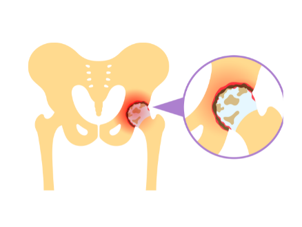 Osteoporosis